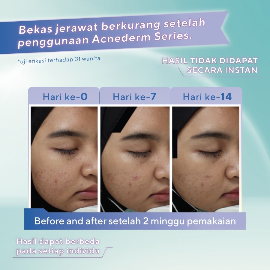wardah acnederm acne care serum 15ml/serum wajah wardah acnederm acne care serum 15ml/serum wajah